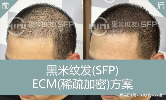 尊龙人生官网黑米纹发(SFP)：植发失败