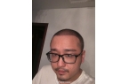 尊龙凯时登录首页LOL笑笑展现植发成果网